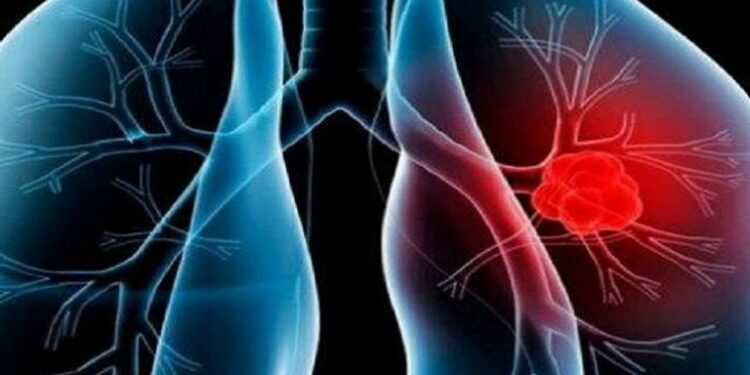 دعوة الى إدراج أدوية مبتكرة في علاج ارتفاع ضغط الدم الشرياني الرئوي