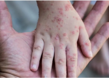 الجزائر لم تسجل أي حالة جدري قردة حتّى الآن
