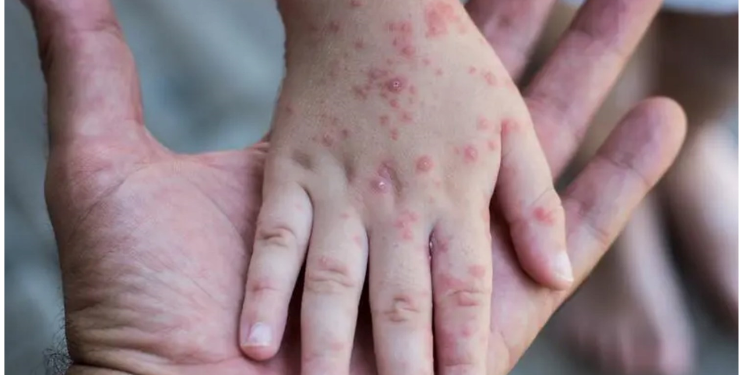 الجزائر لم تسجل أي حالة جدري قردة حتّى الآن